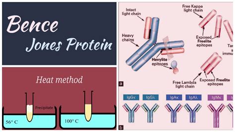 bence jones protein test bottle|bence jones protein interpretation.